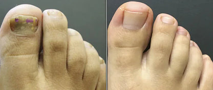 Spray Anti Hongos – Con Veneno de Abeja Natural 🐝